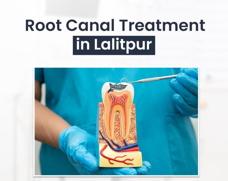 Root Canal Treatment in Lalitpur