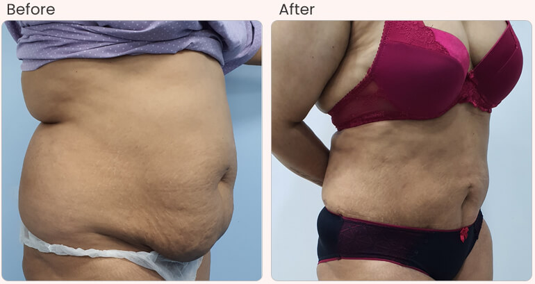 Latest Liposuction Technologies Used by Leading Surgeons