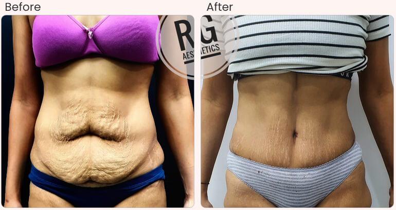 Tummy Tuck Surgery cost in Delhi - Dr Rajat Gupta