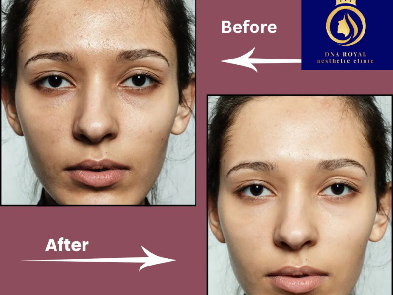 Affordable Chemical Face Peel in Thane | DNA Royal Experts.