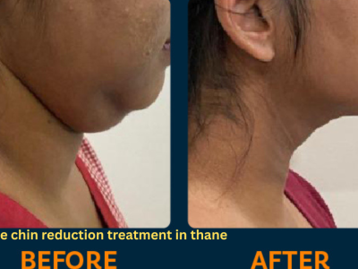 Affordable Double Chin Reduction Treatment in Thane | DNA Royal.
