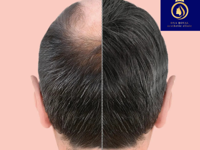 Top Hair Loss Treatment in Thane by DNA Royal Experts.