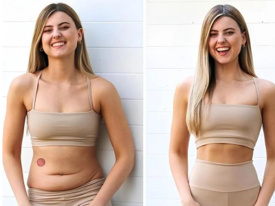 Berberine Patches On Amazon: Natural Fat Loss Solution[Berberine Patches Near Me]