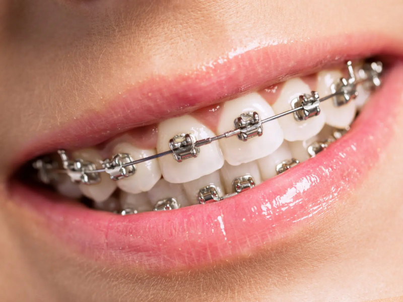 Affordable Braces San Antonio TX | Quality Orthodontic Care at Amini Ortho
