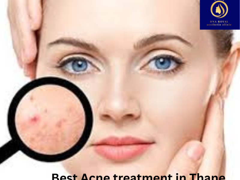 Get the Best Acne Treatment in Thane with DNA Royal Experts.