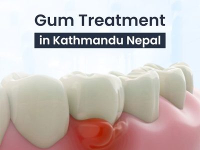 Best Gum treatment in Kathmandu Nepal