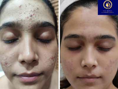 Professional Anti Ageing Skin Care Services in Thane | DNA Royal.