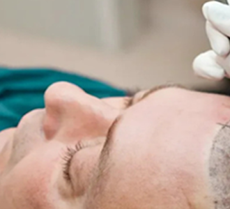 Get Freedom from Baldness with Hair Implant in Delhi
