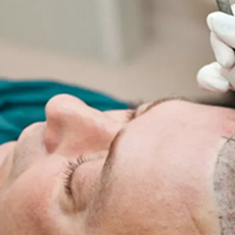 Get Freedom from Baldness with Hair Implant in Delhi