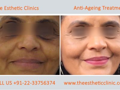 Best Anti-Aging Treatment in Mumbai