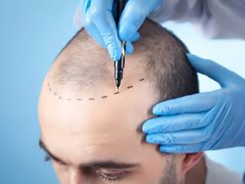 Top-Rated Hair Transplant Surgeon in Delhi for Natural Results