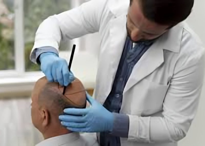 Restore Hair Naturally with Exosomes Hair Transplant in Delhi