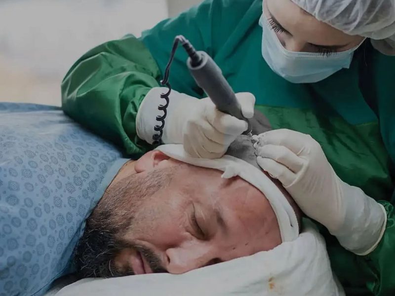Restore Your Hair with Advanced FUT Hair Transplant