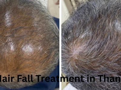 Best Hair Fall Treatment in Thane – Expert Solutions at DN A Royal.