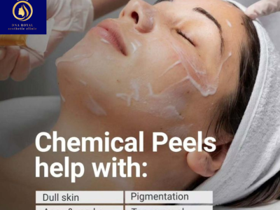 Get Radiant Skin with Chemical Face Peel in Thane at DNA Royal.