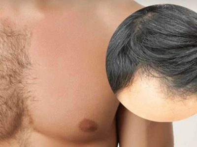 Not Enough Scalp Hair? No PROBLEM | Get Fuller Coverage with Body Hair Transplant