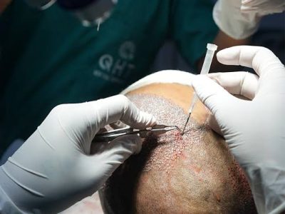Trusted Hair Transplant Clinic in the UAE for Natural Results