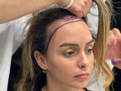 Trusted Hair Transplant Clinic in the UAE for Natural Results