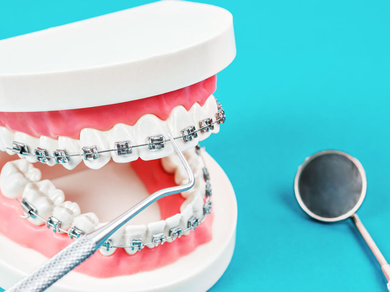 Metal Braces in San Antonio for a Straighter, Healthier Smile