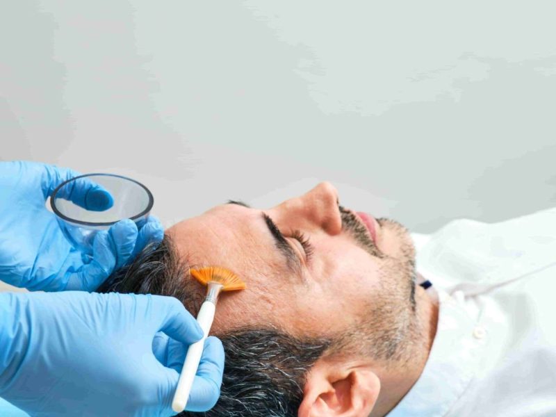 Best Chemical Peel Treatment in Bengaluru
