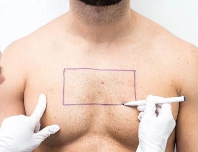 Hair Transplant Treatment in Hanamkonda