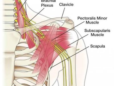 Brachial Plexus Injury Treatment in Gurgaon | Expert Physiotherapy & Nerve Rehabilitation