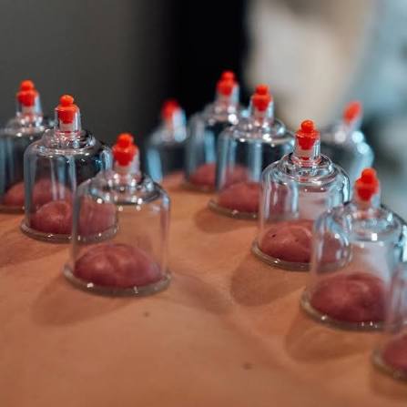 Best Cupping Therapy Services in Gurgaon | Pain Relief & Recovery