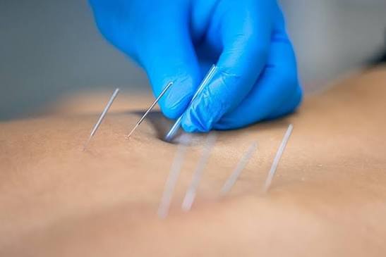 Dry Needling Services in Gurgaon – Expert Pain Relief & Muscle Recovery