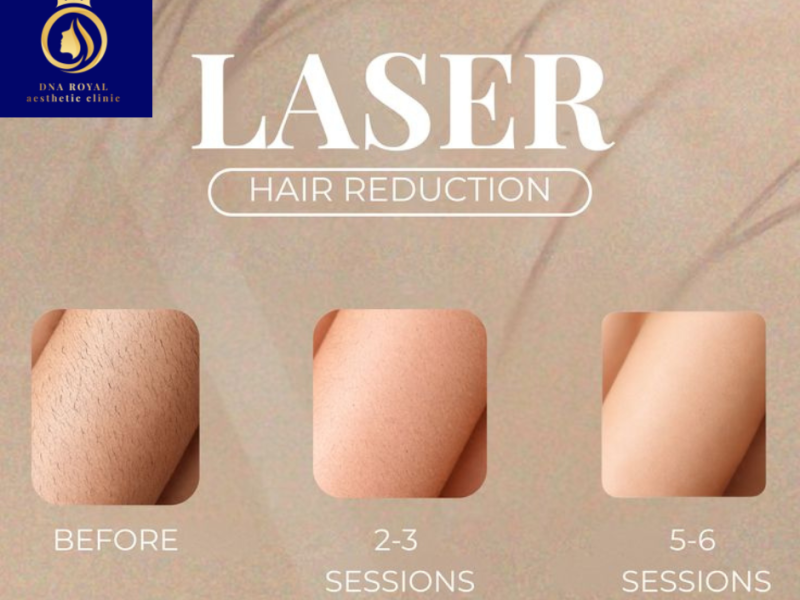 Experience the Best Laser Hair Removal in Thane with DNA Royal.