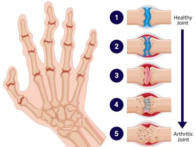 Rheumatoid Arthritis Treatment in Gurgaon | Expert Physiotherapy for Joint Pain Relief