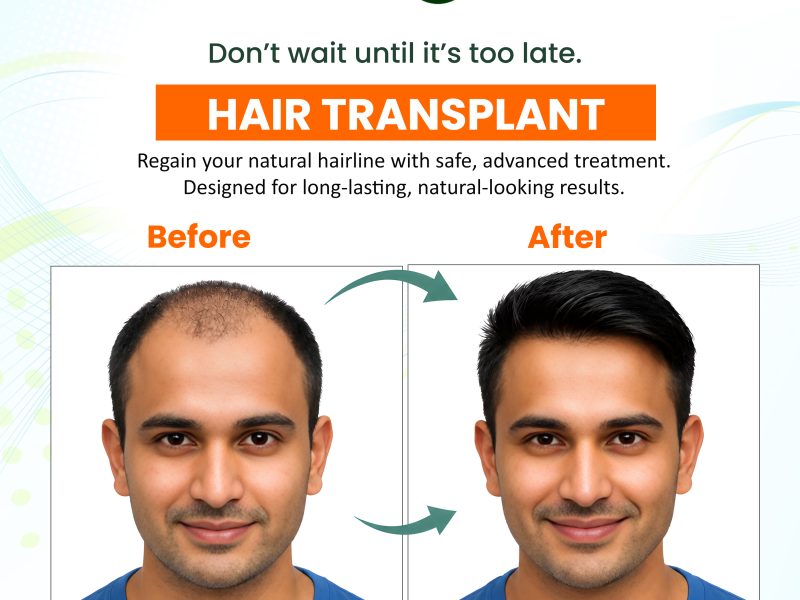 Best Hair Transplant Treatment in Hanamkonda