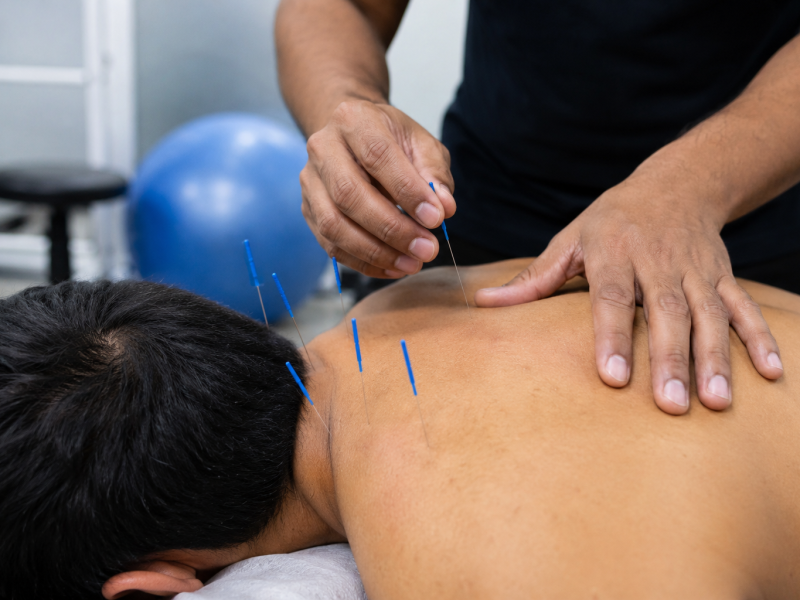 Why Dry Needling Physiotherapy Is Helping More People Recover from Persistent Muscle Pain in Gurgaon
