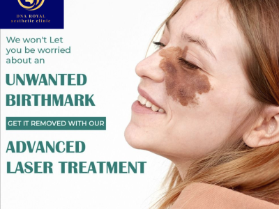 Advanced Laser Birthmark Removal in Thane | DNA Royal Skin Clinic.