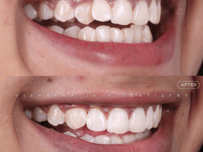Smile Design Dentist in Indore – Personalized Smile Makeover