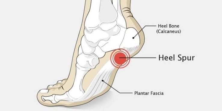Calcaneal Spur Treatment in Gurgaon | Expert Heel Pain Physiotherapy