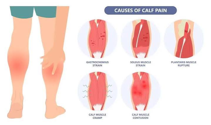 Calf Strain Treatment in Gurgaon | Expert Physiotherapy for Fast Recovery