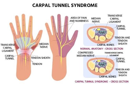 Carpal Tunnel Syndrome Treatments in Gurgaon | Expert Physiotherapy for Wrist & Hand Pain