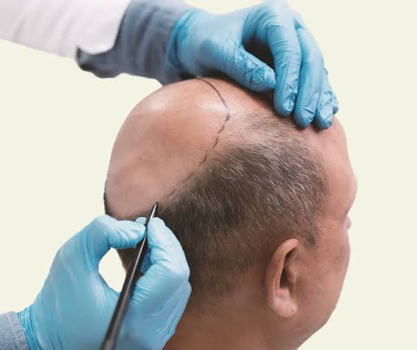 Activate Your Hair's Natural Power with PRP Treatment in Delhi!