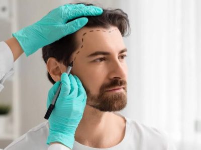 Reclaim Your Hairline with the Best FUT Hair Transplant in Delhi!