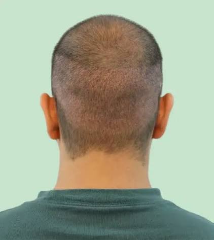 Celebrate Your Curls with Expert Afro Hair Transplant at Dr. Haror's Wellness!