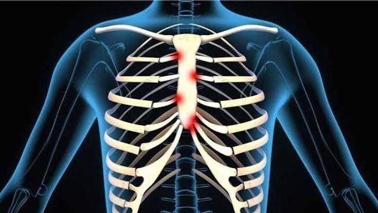 Costochondritis Physiotherapy Treatment in Gurgaon | Expert Physiotherapy for Chest Wall Pain Relief