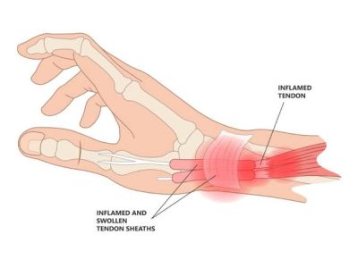 De Quervain Tenosynovitis Treatment in Gurgaon | Expert Physiotherapy for Wrist & Thumb Pain