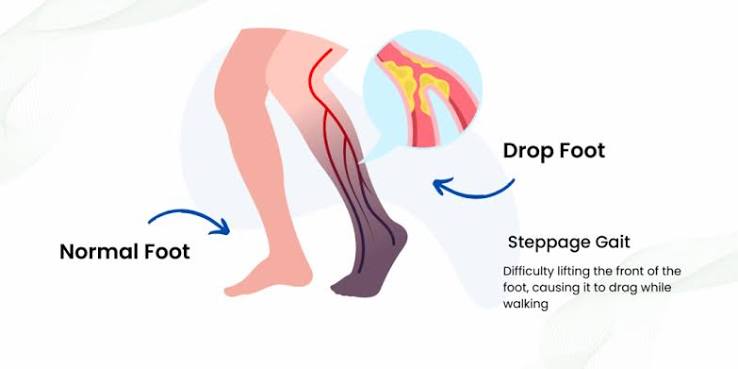 Foot Drop Treatment in Gurgaon | Expert Physiotherapy for Faster Recovery