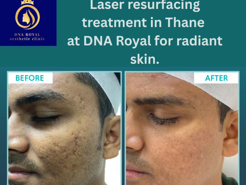 Affordable Laser Resurfacing Treatment in Thane | DNA Royal Experts.