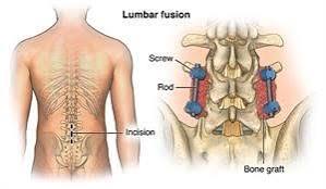 Lumbar Spinal Stenosis Treatment in Gurgaon : Effective Treatment for Professional Physiotherapists