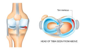 Meniscus Injury in Gurgaon : Repairing Mobility using the highest level of precision