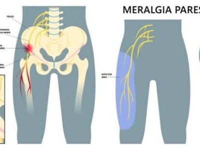 Meralgia Paresthetica Treatment in Gurgaon : Expert Physiotherapists in Gurgaon