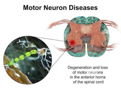 Motor Neuron Disease Treatment in Gurgaon : Expert Physiotherapy Services for Motor Neuron Disease