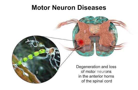 Motor Neuron Disease Treatment in Gurgaon : Expert Physiotherapy Services for Motor Neuron Disease