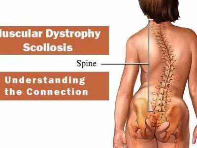 Muscular Dystrophy Treatment in Gurgaon : effective physiotherapy treatment to patients